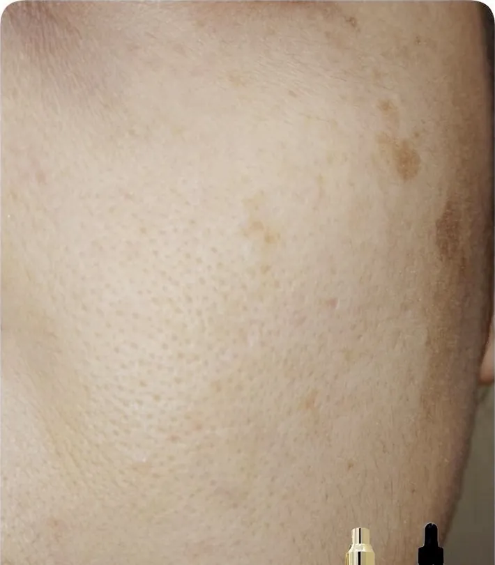 After：頬のアップ（施術前後）