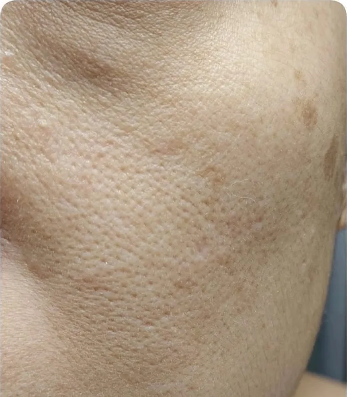 Before：頬のアップ（施術前後）
