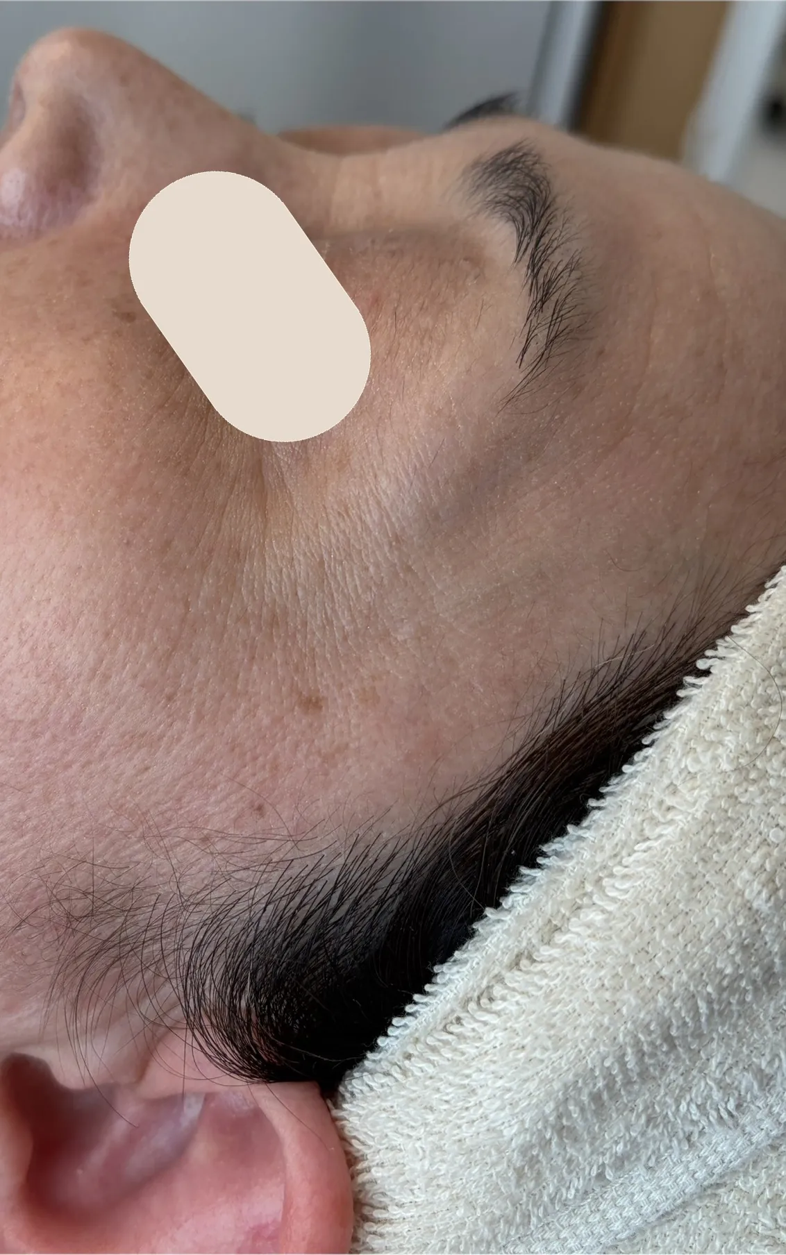 Before：横顔・頬から目元（施術前後）